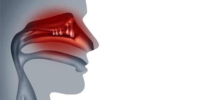 medical-concept-of-sinus-polyps-Nasal-&-Sinus-Surgery