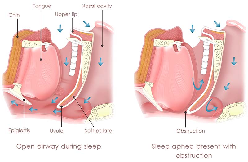 understanding-the-need-for-sleep-apnea-surgery-Nasal-&-Sinus-Surgery